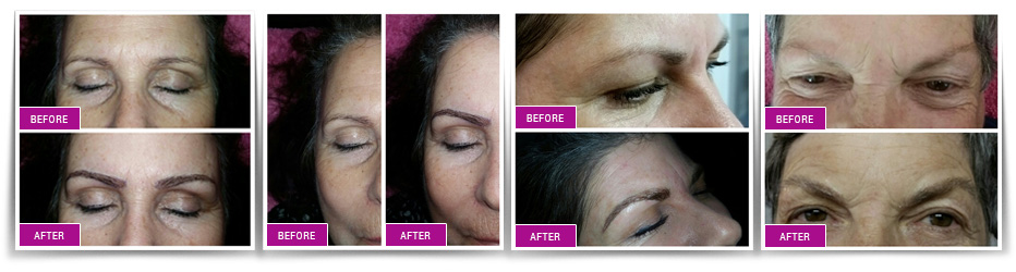 Microblading